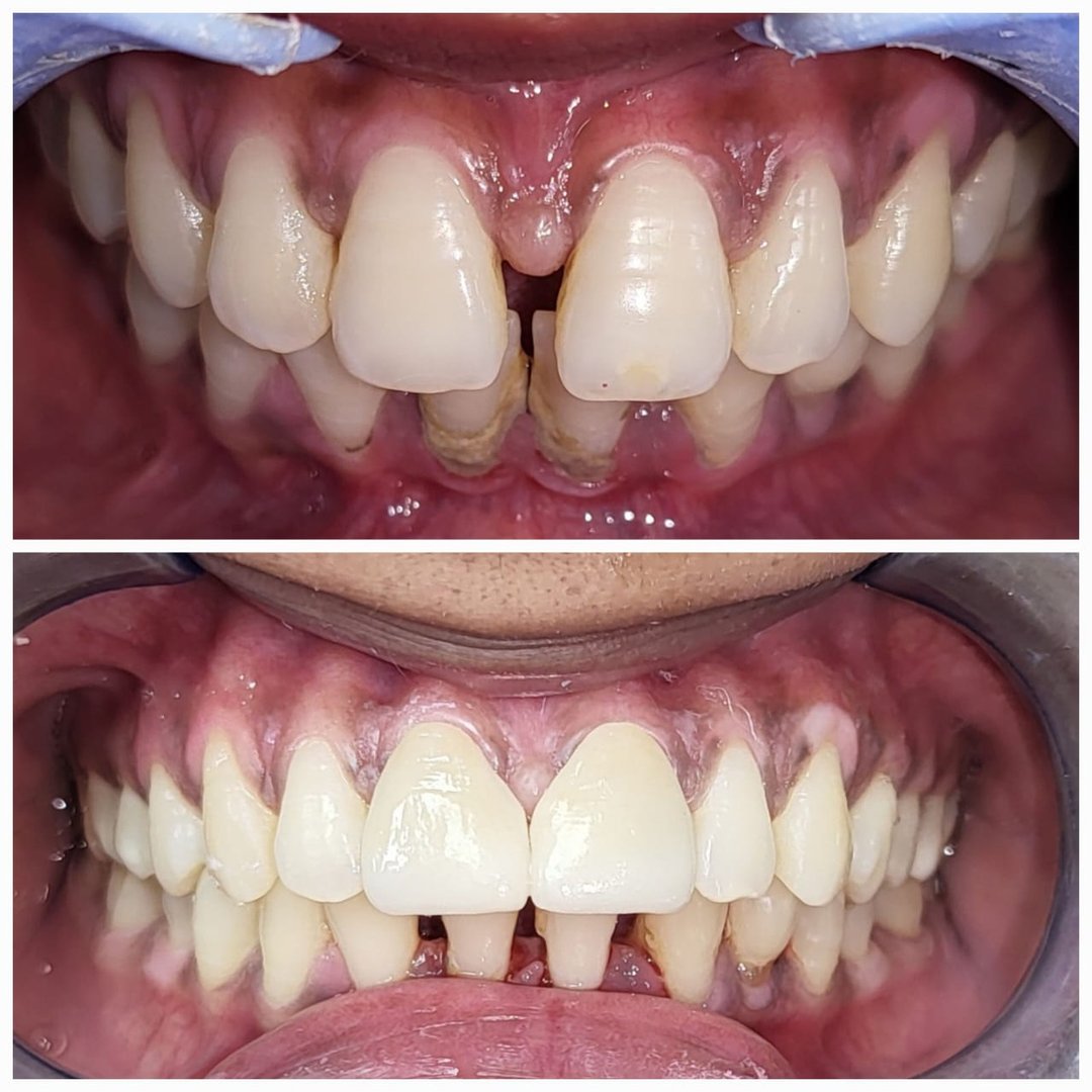 Diastema Diastema