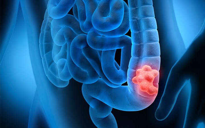 colon cancer treatment in Bangalore