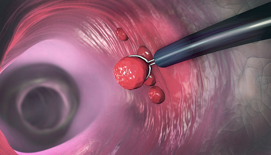 Endoscopic surgery  in Bangalore