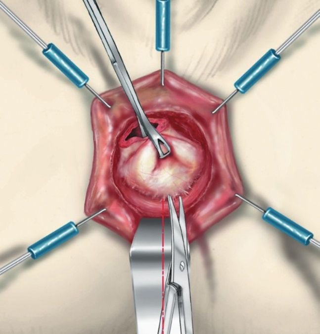 Intersphincteric resection in Bangalore