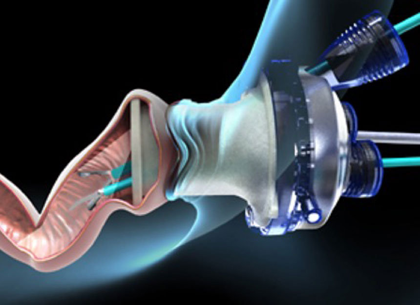 Transanal minimally invasive surgery 