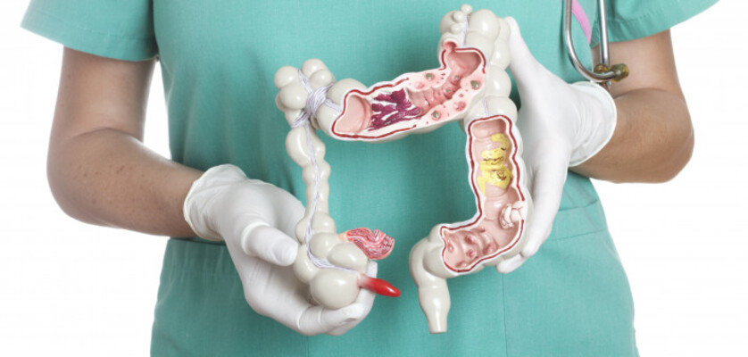colon cancer colon cancer