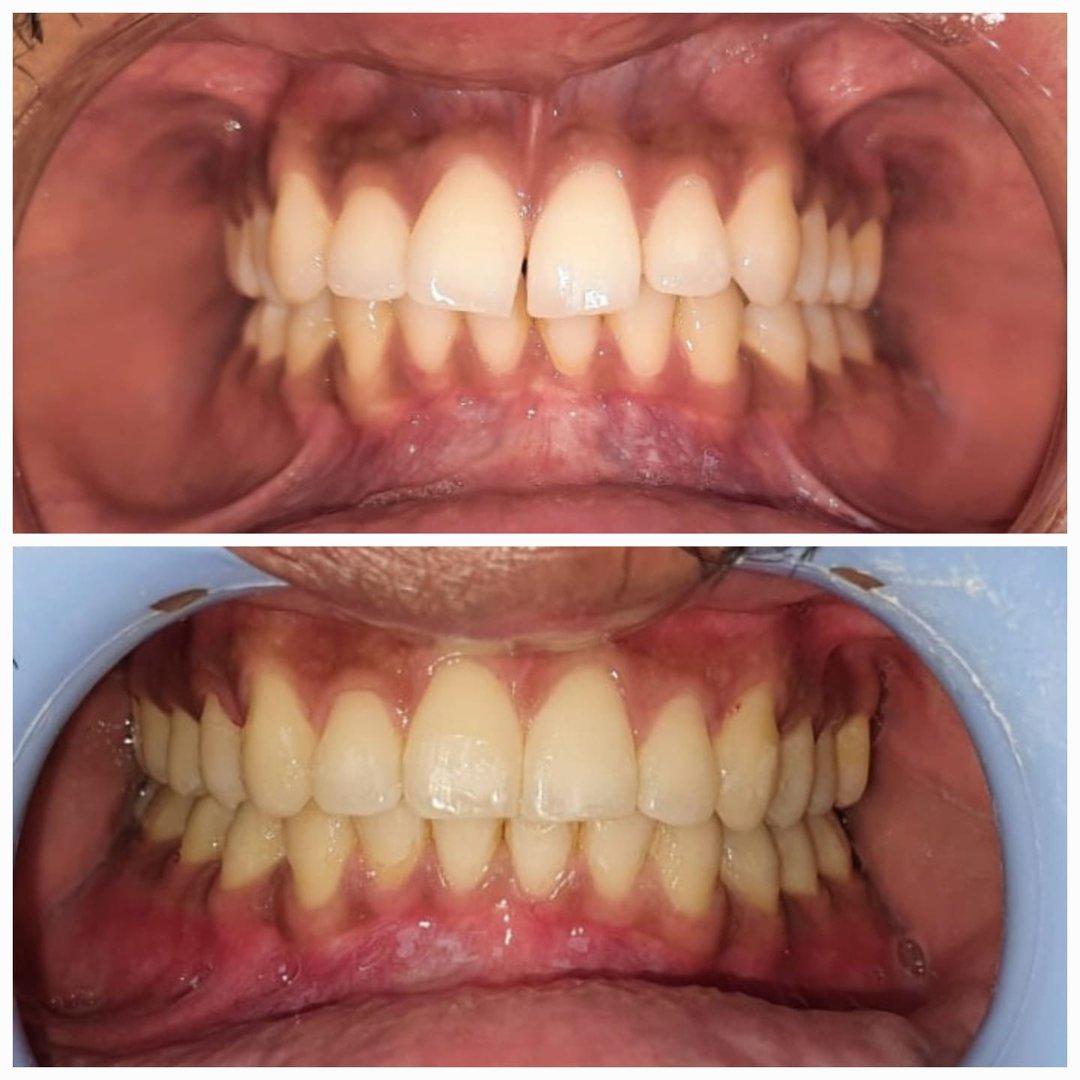 Orthodontic correction using invisible braces Orthodontic correction using invisible braces