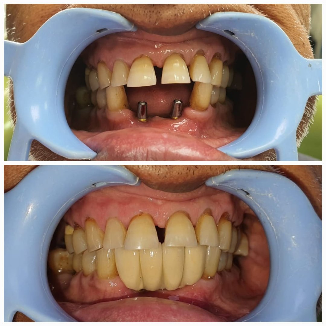 Rehabilitation in a case of lost soft tissue using dental implants Rehabilitation in a case of lost soft tissue using dental implants