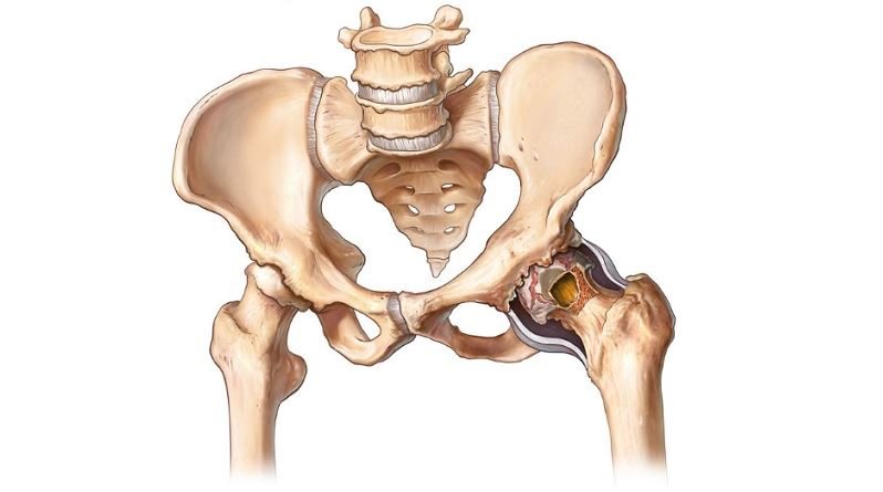 The Global Hip Reconstruction Market