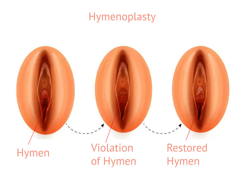 hymenoplasty