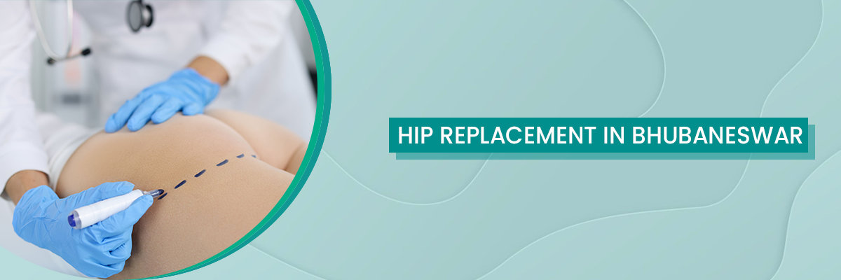 Hip Replacement Hip Replacement