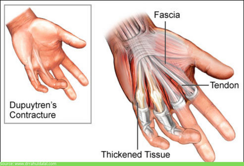 Dupuytren's disease