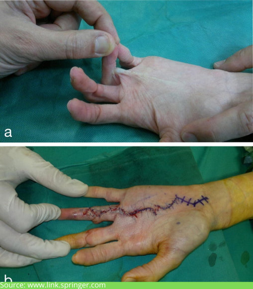 Dupuytren’s disease in Mumbai