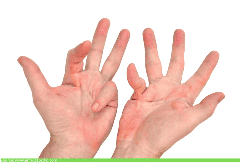 Dupuytren’s disease