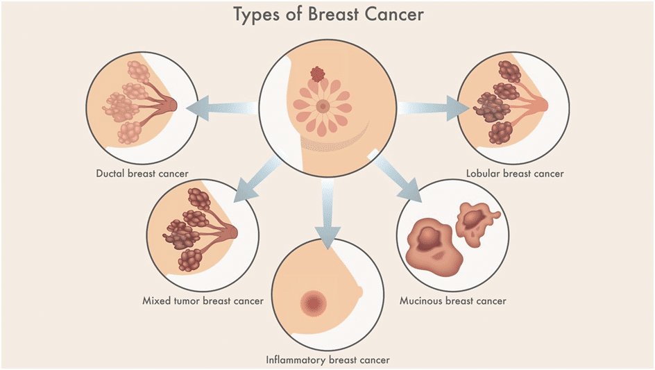 breast cancer in bangalore