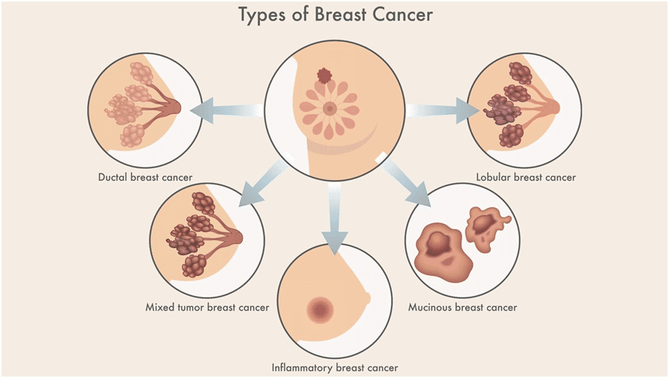 breast cancer in bangalore