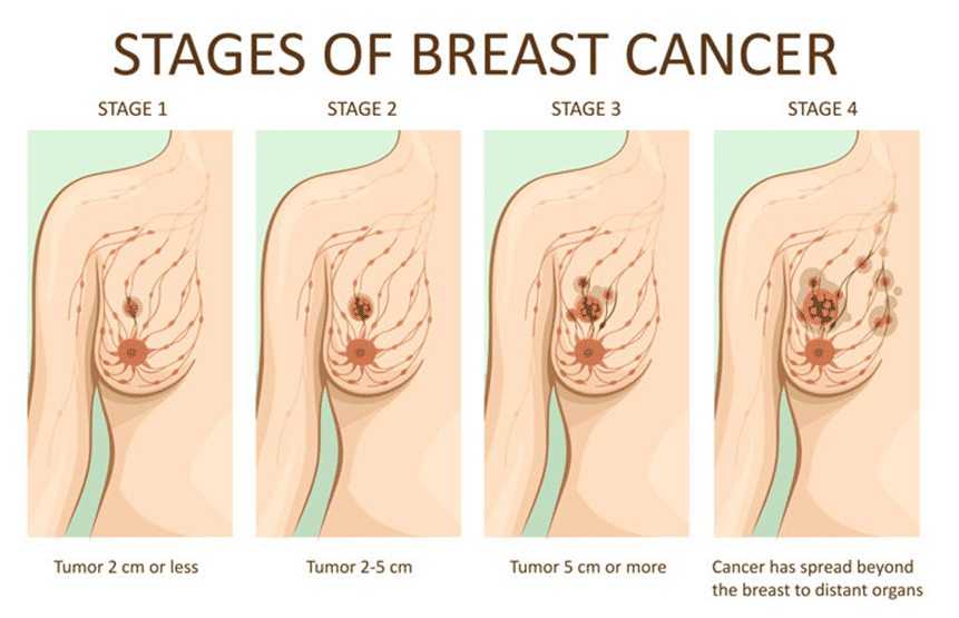 Breast cancer stages