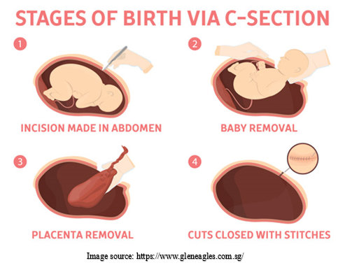 C-Section delivery