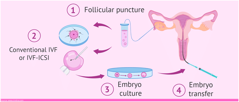  IVF procedure 