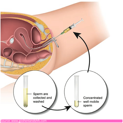 IUI (intrauterine insemination)