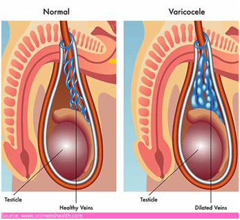 Varicocelectomy