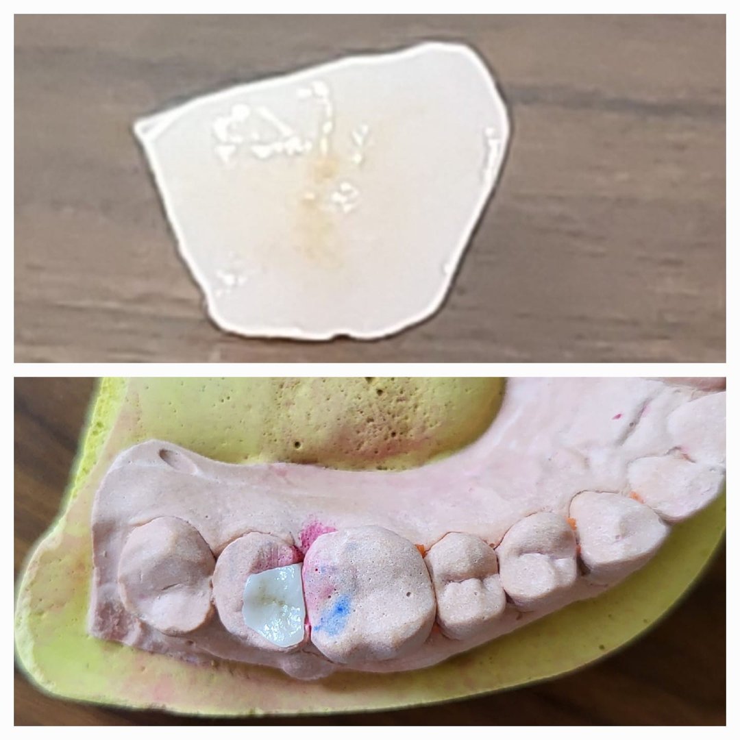 All ceramic Inlay, the most conservative way to replace a huge cavity in a tooth All ceramic Inlay, the most conservative way to replace a huge cavity in a tooth