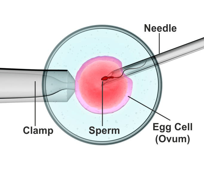 icsi treatment