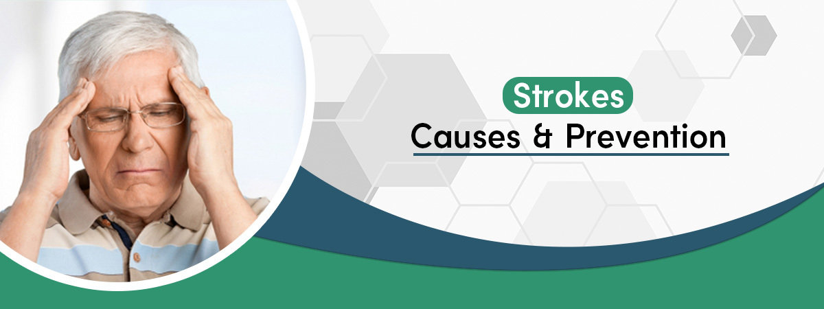 Strokes: Causes And Prevention Strokes: Causes And Prevention