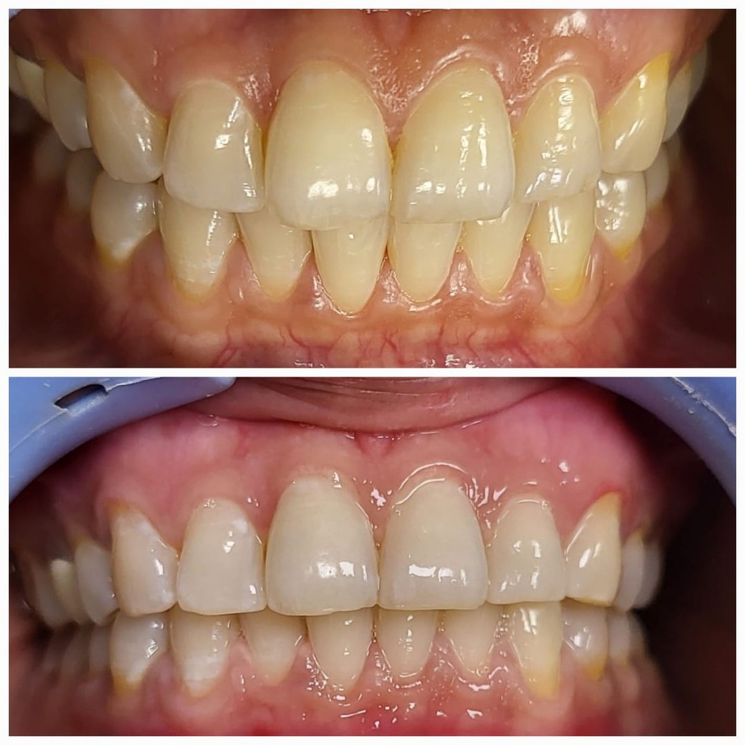 Single visit one application laser teeth whitening Single visit one application laser teeth whitening