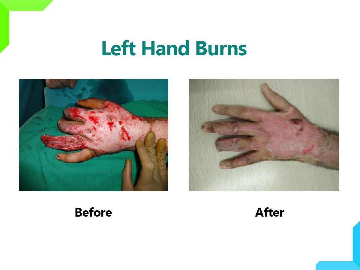 Left hand burns Left hand burns