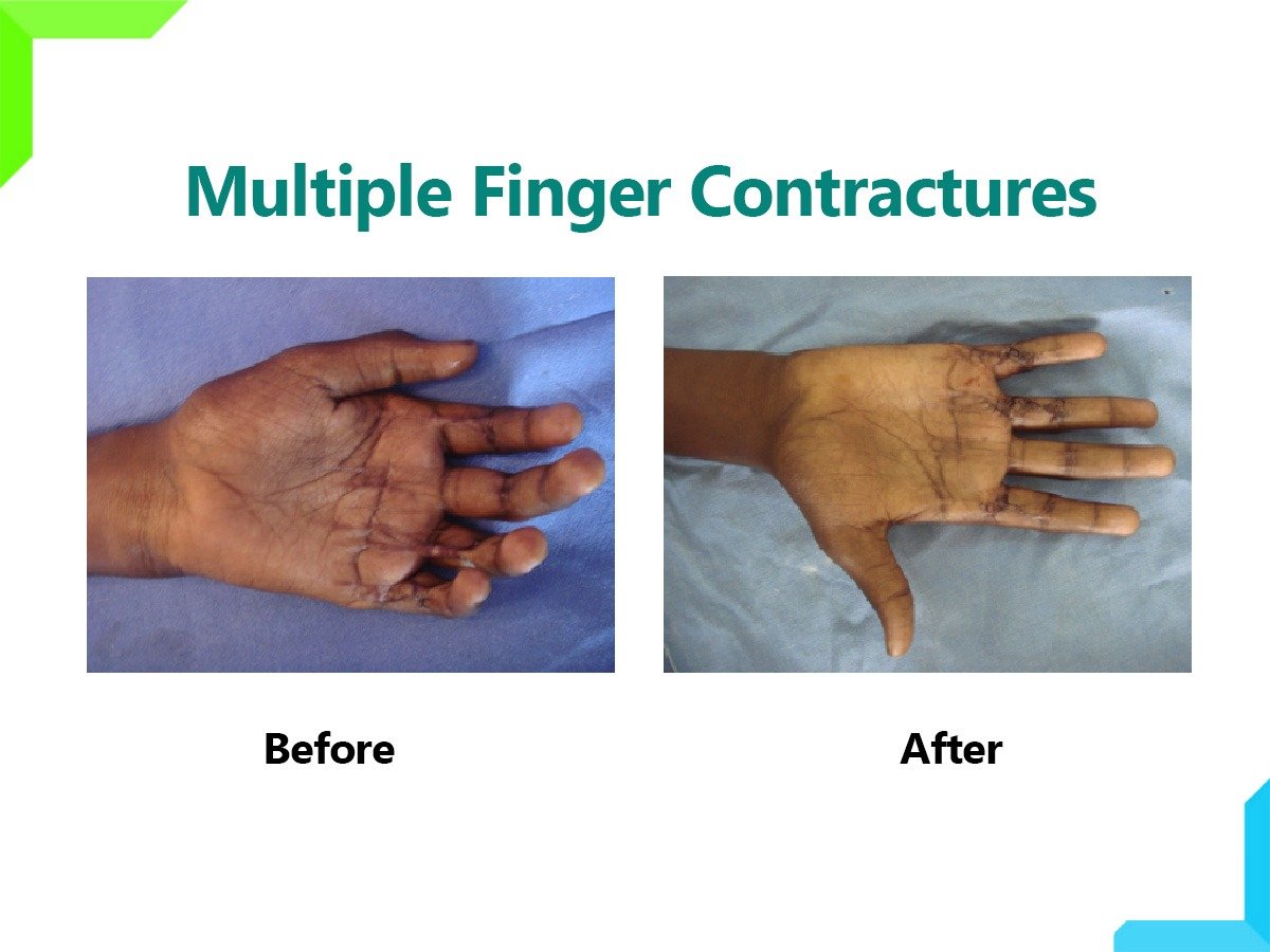 Finger contractures Finger contractures