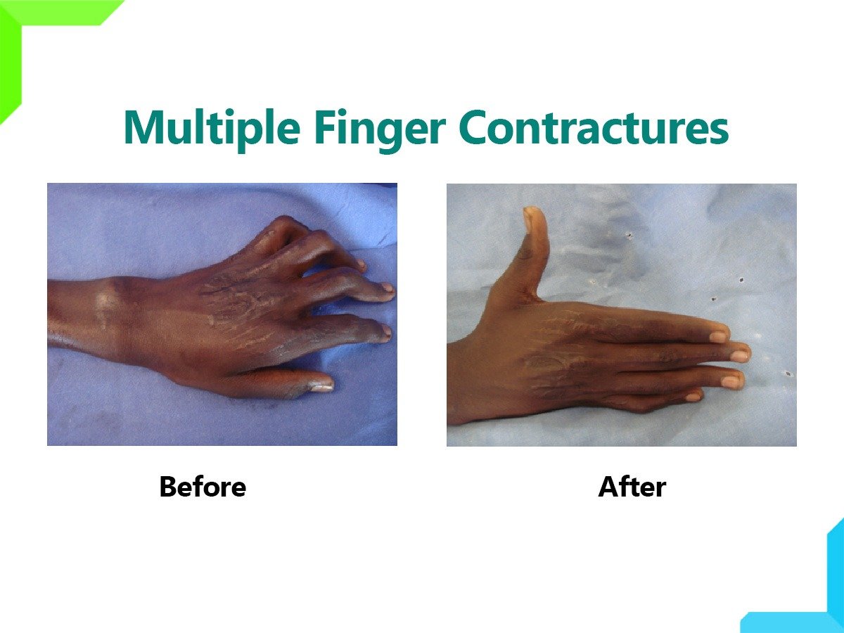 Finger contractures Finger contractures