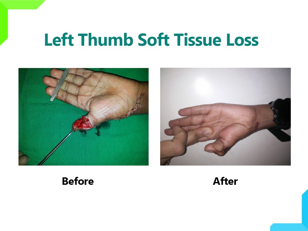 soft tissue loss soft tissue loss