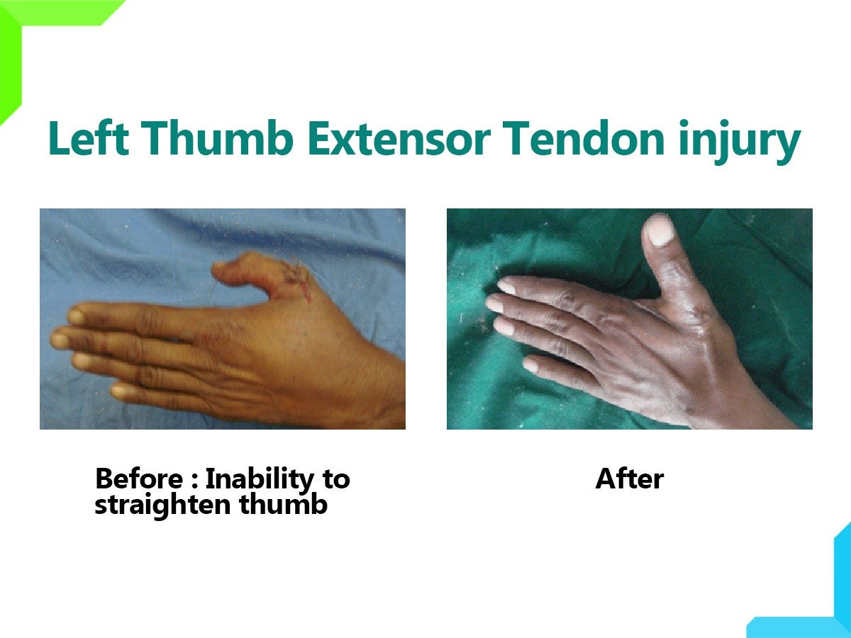 Thumb extensor tendon injury Thumb extensor tendon injury