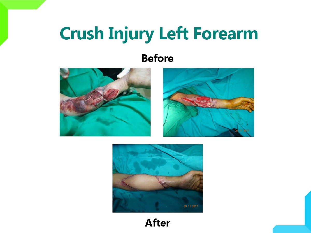 Crush Injury left forearm Crush Injury left forearm