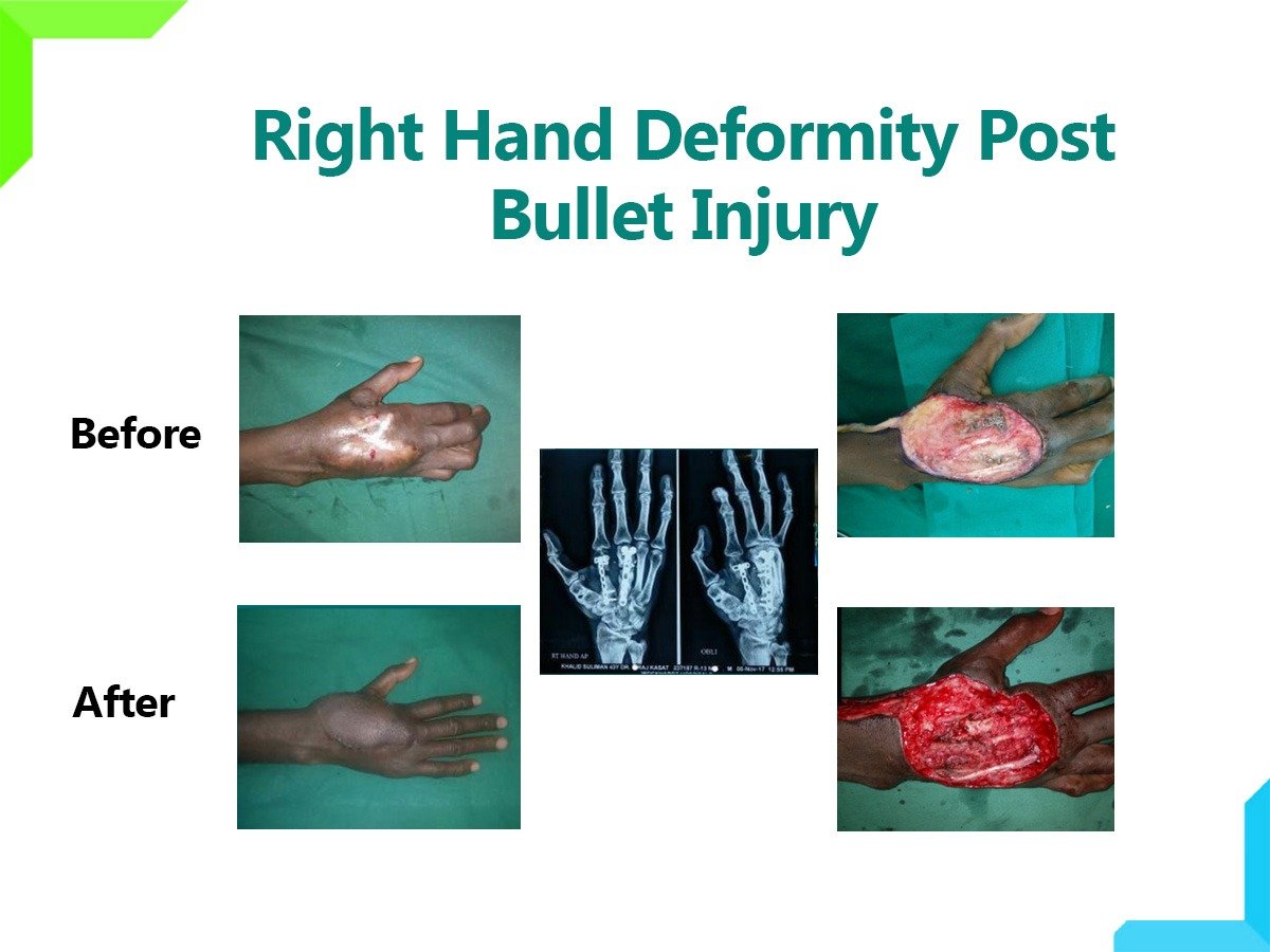 bullet injury bullet injury