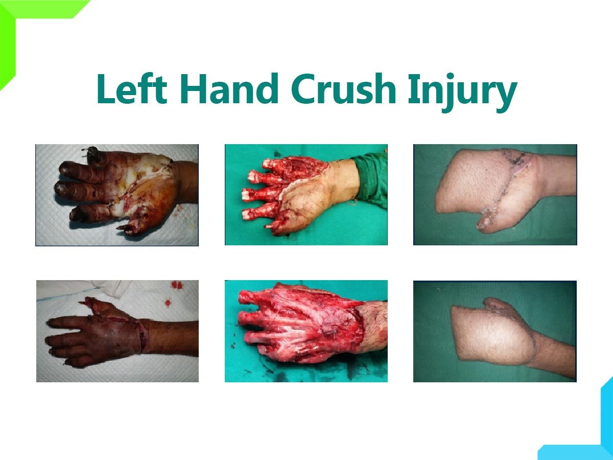 hand injury hand injury