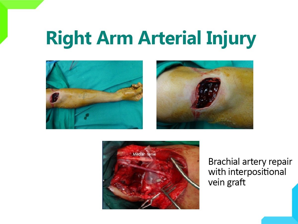 arm arterial injury arm arterial injury