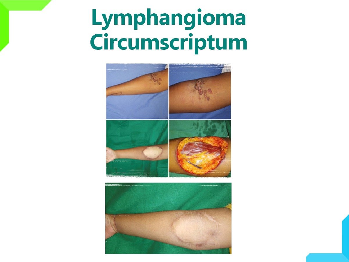 Lymphangioma Circumscriptum Lymphangioma Circumscriptum