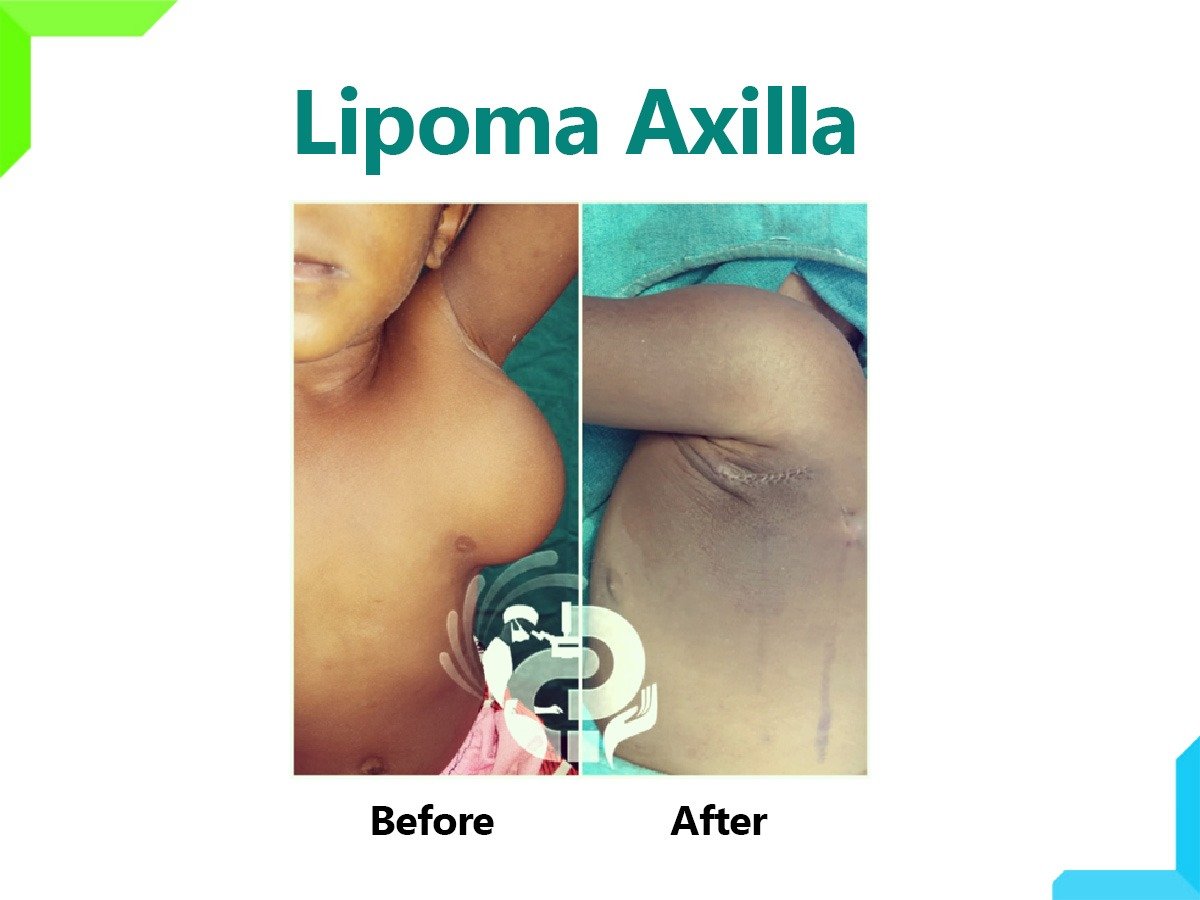 lipoma axilla lipoma axilla