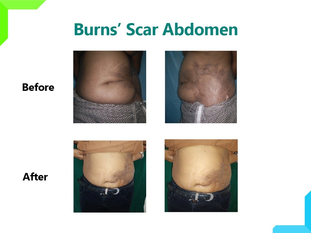 burn scar burn scar