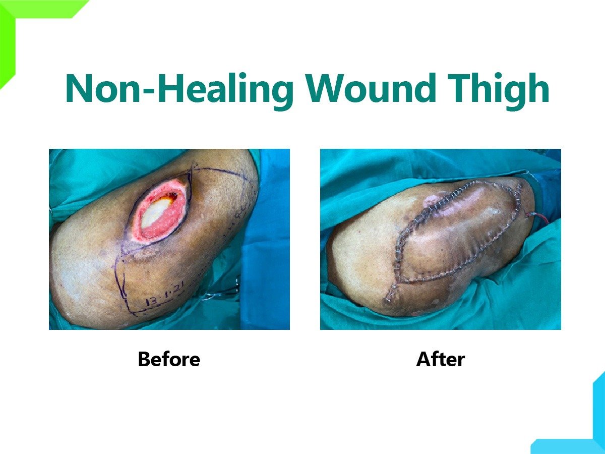 wound wound