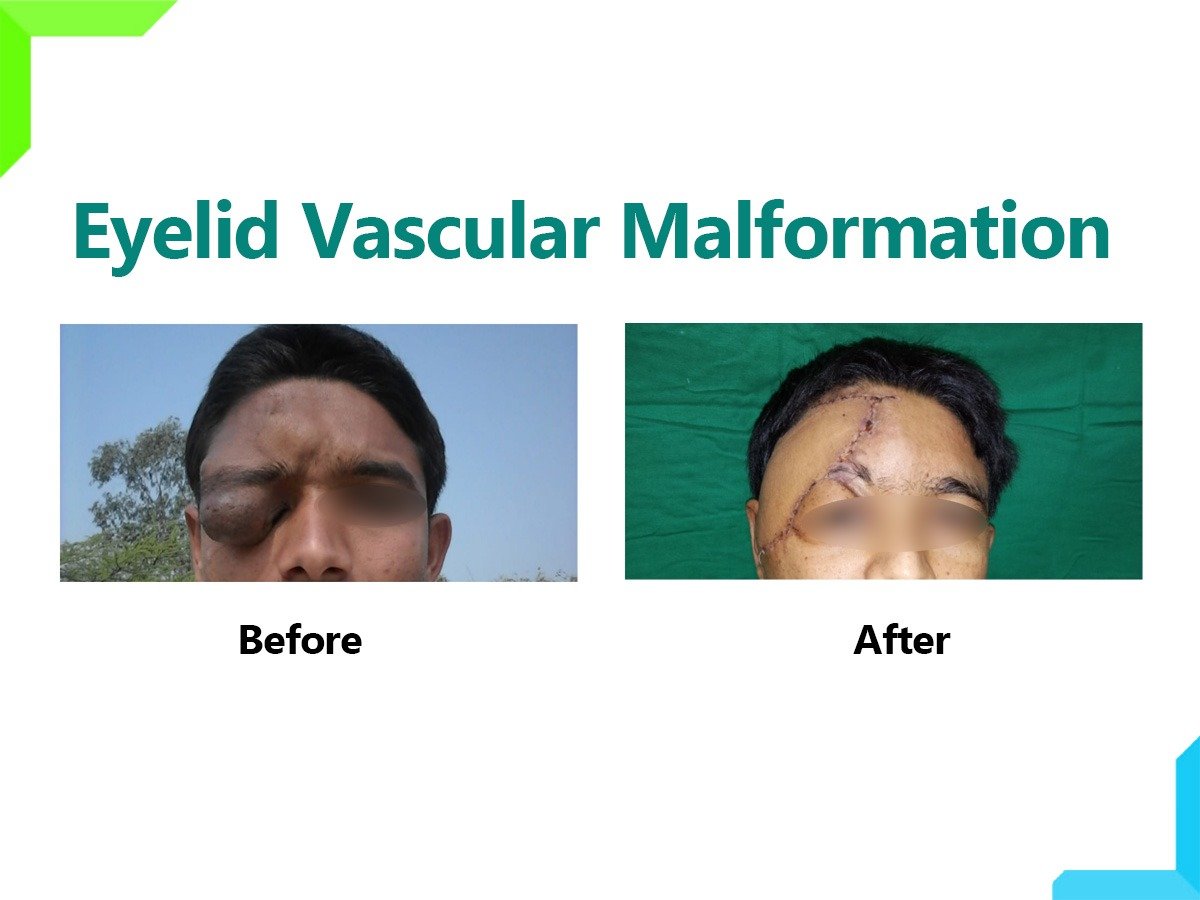 Eyelid Vascular Malformation Eyelid Vascular Malformation