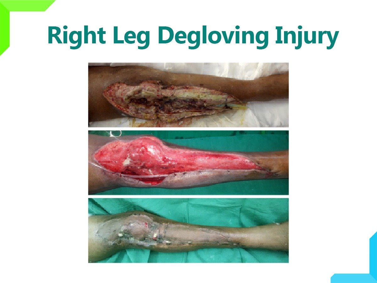 Leg Degloving Injury Leg Degloving Injury