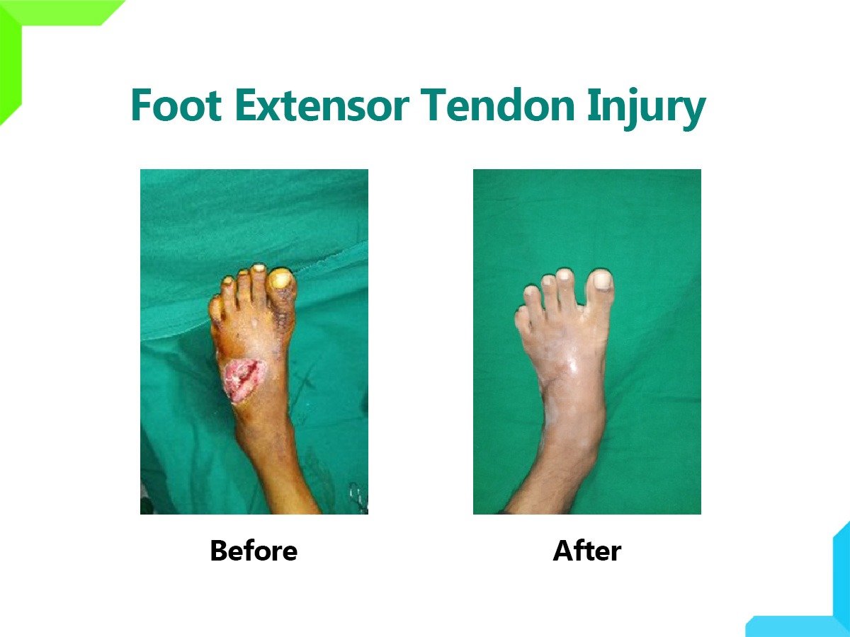 Foot extensor tendon injury Foot extensor tendon injury