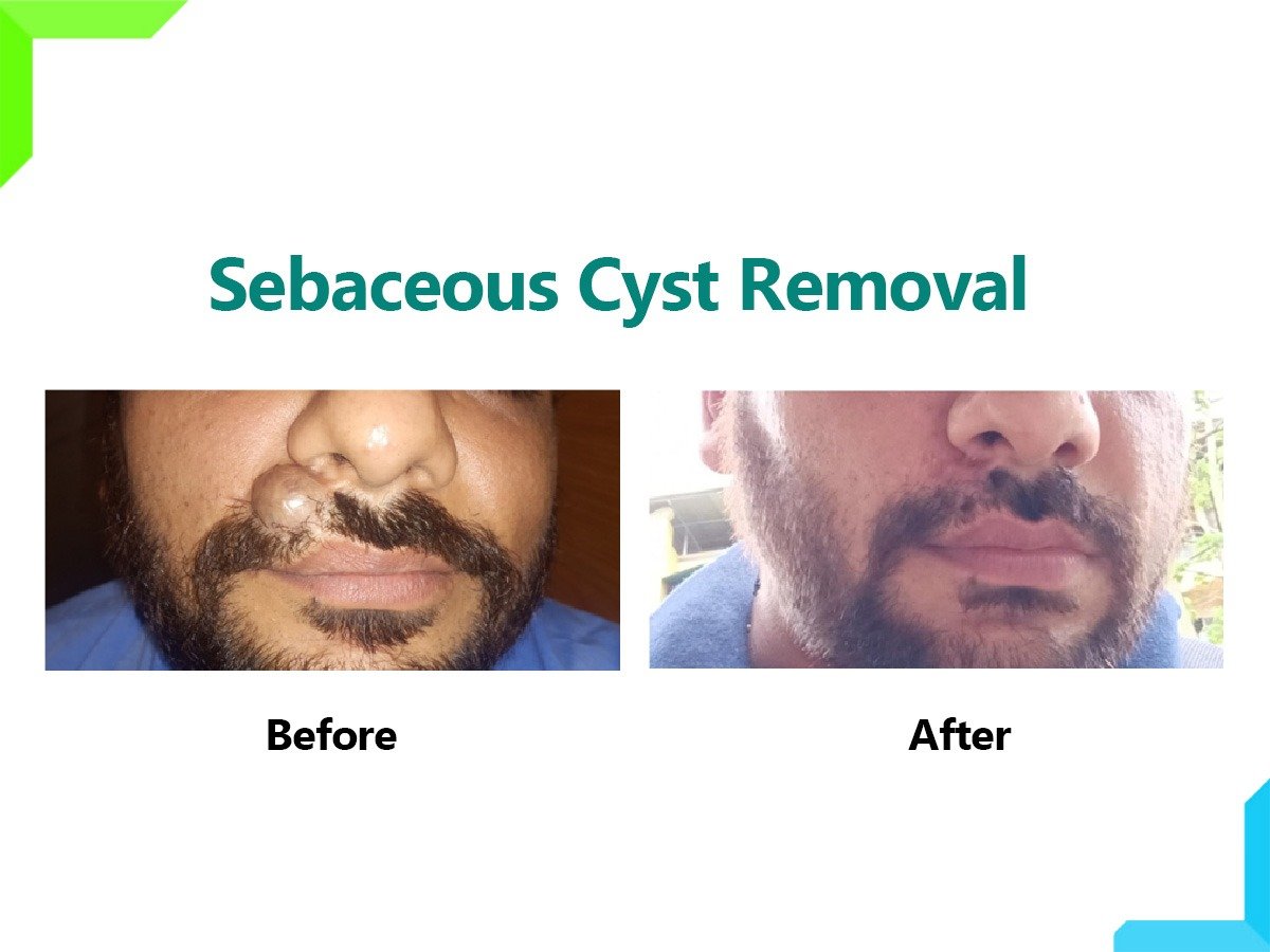Sebaceous Cyst Removal Sebaceous Cyst Removal