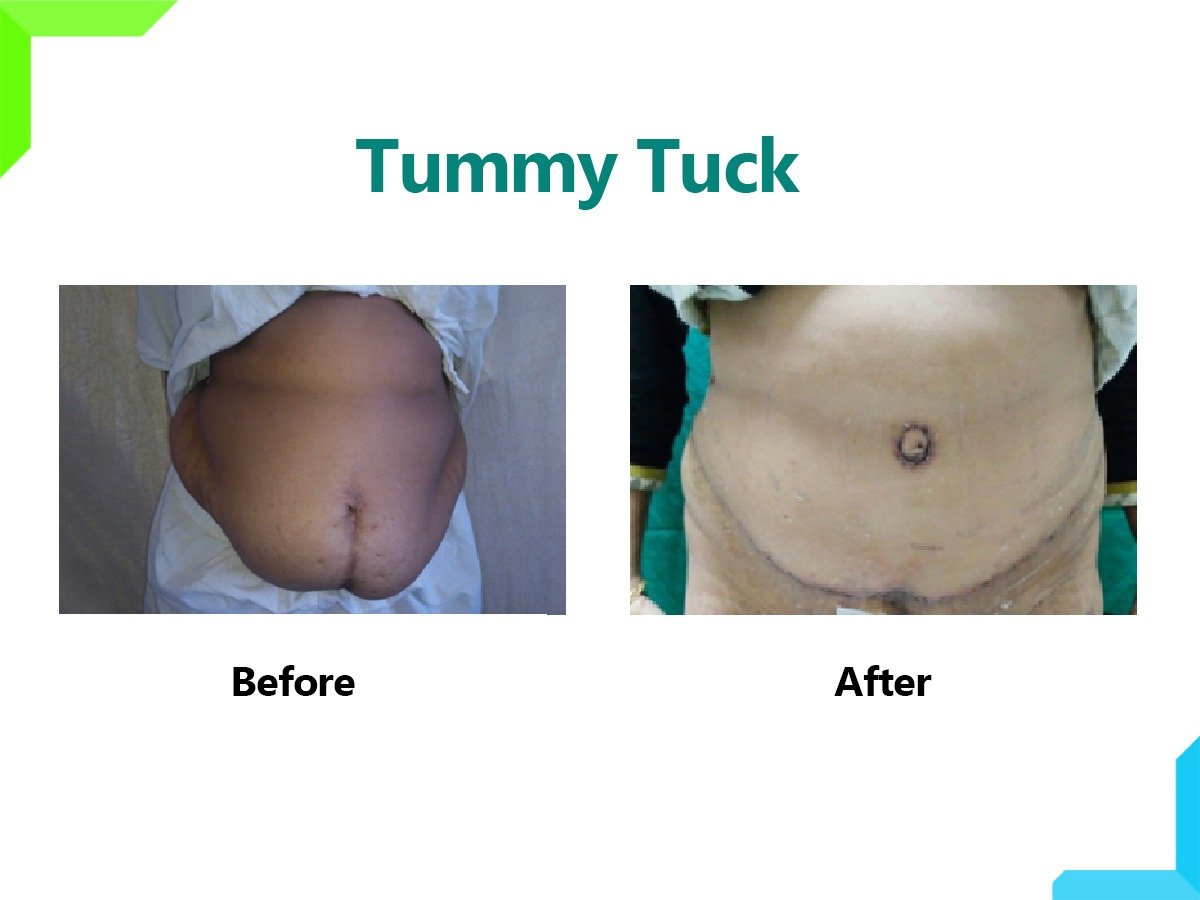Tummy tuck in mumbai Tummy tuck in mumbai