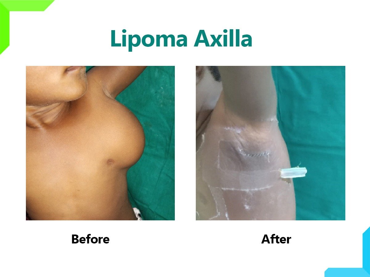 Lipoma Axilla in mumbai Lipoma Axilla in mumbai