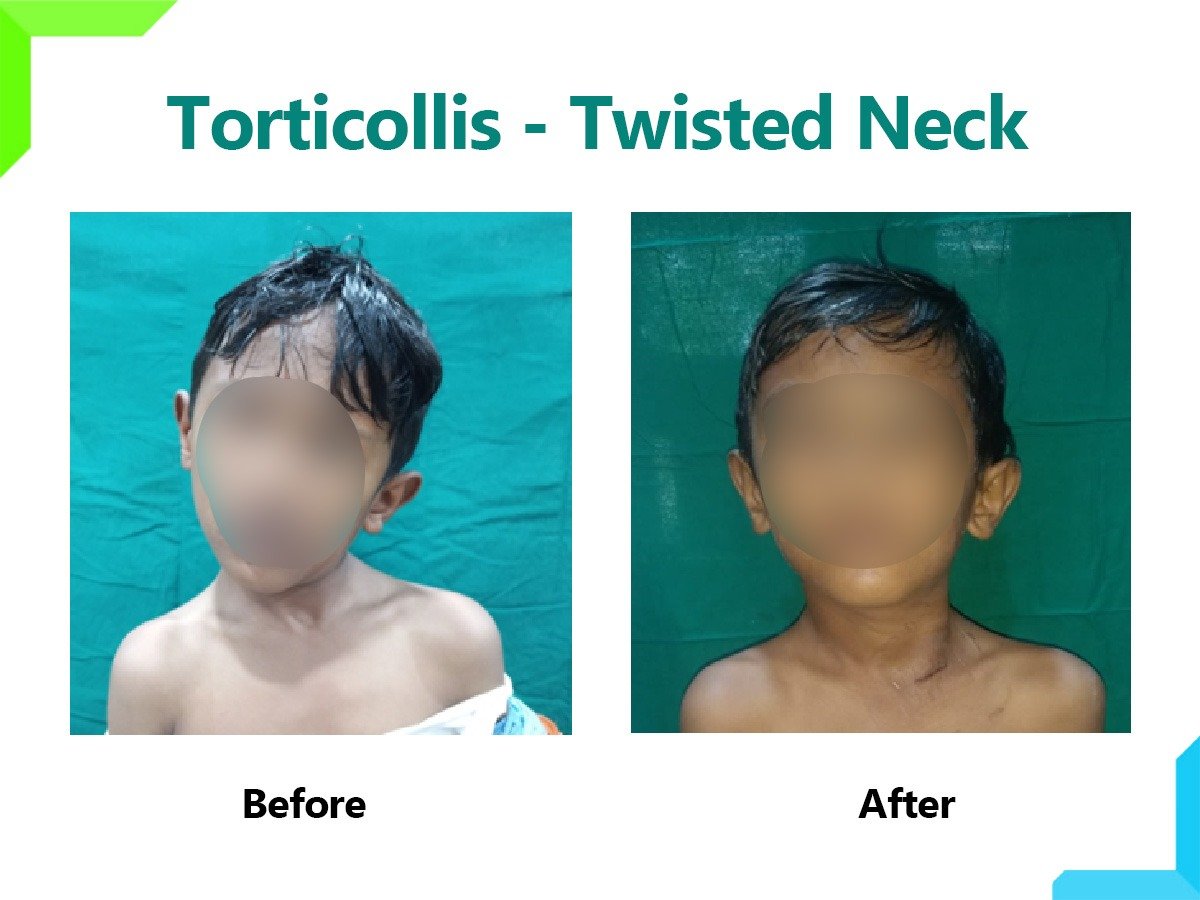 Torticollis treatment in Mumbai Torticollis treatment in Mumbai