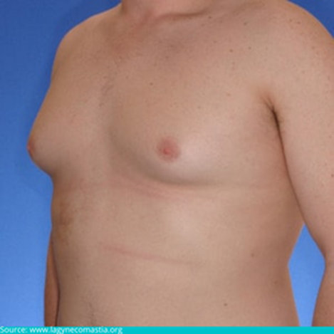 Gynecomastia