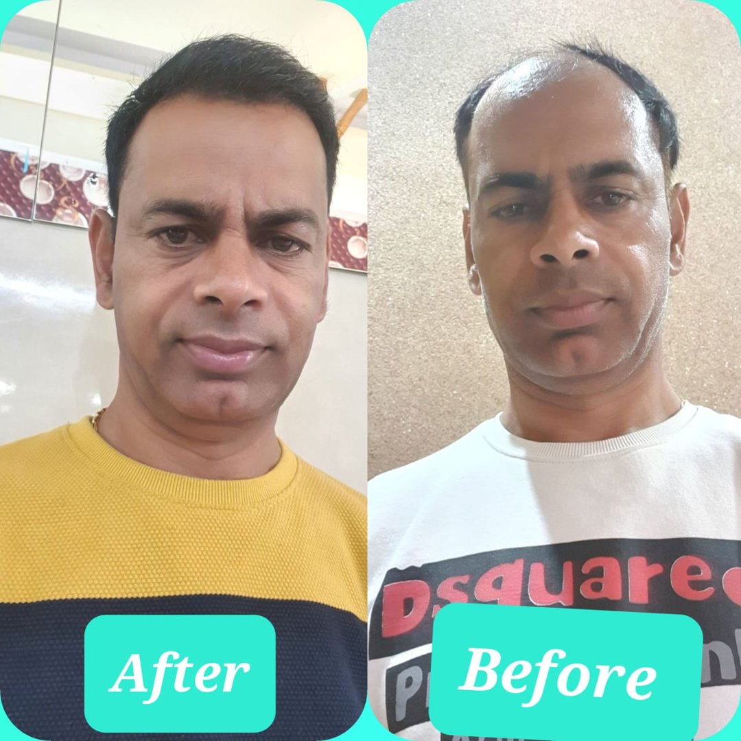 Before after image for hair transplant Before after image for hair transplant