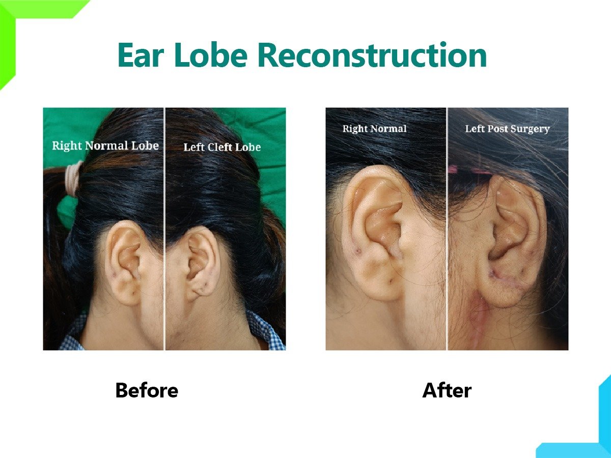 ear lobe reconstruction ear lobe reconstruction