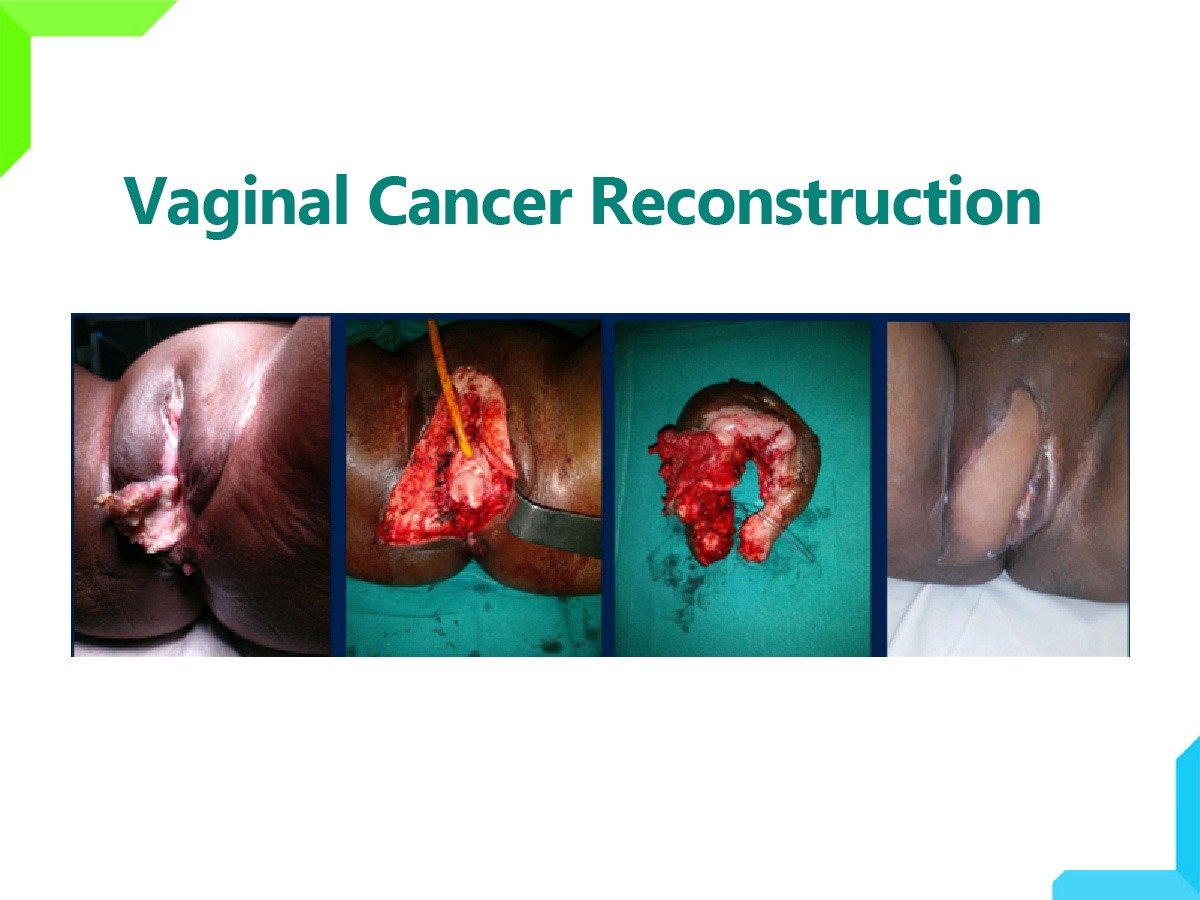 vaginal cancer vaginal cancer