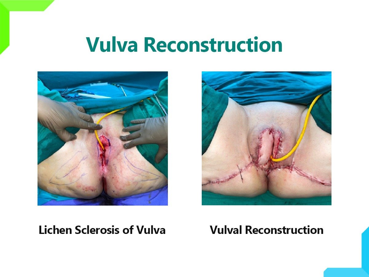 vulva vulva